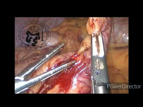Appendektomia laparoskopowa - OZWR