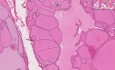 Wole koloidowe - histopatologia tarczycy