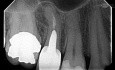 Chirurgia endodontyczna pod mikroskopem