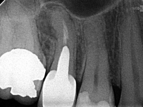 Chirurgia endodontyczna pod mikroskopem