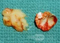 Śluz z wnętrza małżowiny puszkowej (wycinek chirurgiczny)
