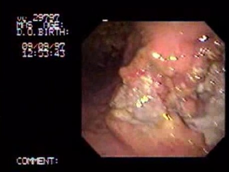 Gruczolakorak żołądka - obstrukcja - endoskopia