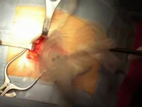 Chirurgiczna operacja przepukliny udowej