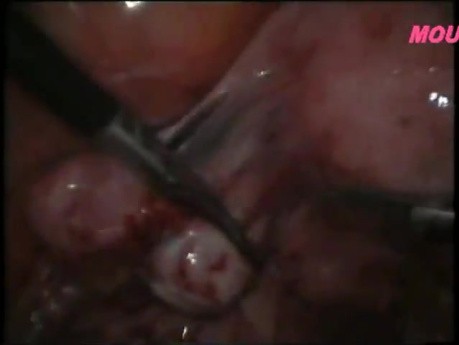 Usunięcie zwężeń okołojajowodowych z użyciem laparoskopii
