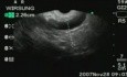 Wewnątrzprzewodowy brodawkowo-śluzowy nowotwór trzustki (IPMT III) - endoultrasonografia (EUS) z biopsją cienkoigłową