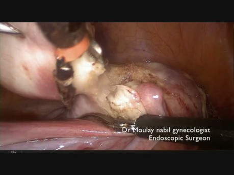 Okluzja tętnic macicznych przez podejście środkowe i miomektomia