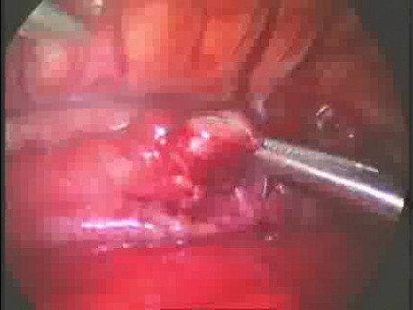 Zarośnięcie przełyku (atrezja przełyku) - operacja torakoskopowa u noworodka