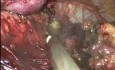 Laparoskopowy bypass żołądka sposobem Roux-en-Y