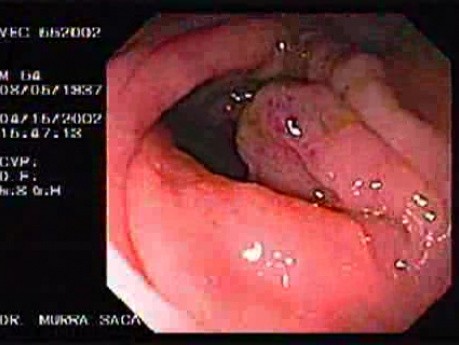 Zespół Zollingera-Ellisona - wrzód żołądka, wrzody żołądka i przetoka żołądkowo-okrężnicowa (2 z 21)