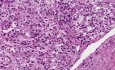 Rak nerkowokomórkowy - histopatologia - nerka