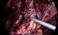 Martwiczo zmieniony i trudny pęcherzyk żółciowy
