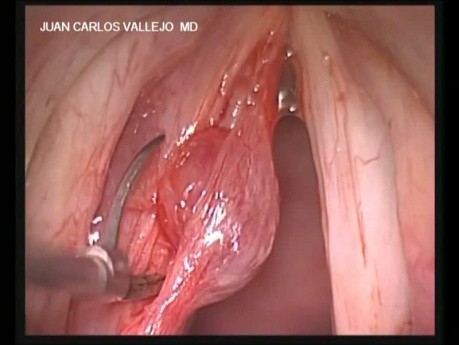 Minimalnie inwazyjne wycięcie torbieli fałdu głosowego lewego