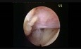 Endoskopowa dyscektomia kręgosłupa w odcinku lędźwiowym - dostęp interlaminarny