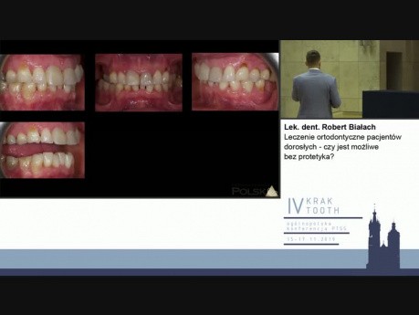 Leczenie ortodontyczne pacjentów dorosłych - czy jest możliwe bez protetyka? - Kraktooth 2019