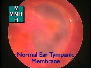 Endoskopowy obraz prawidłowej błony bębenkowej