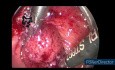 Przezodbytowa mikrochirurgia endoskopowa (TEM)