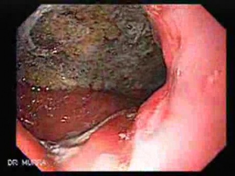 Gruczolakorak żołądka naciekający krzywiznę mniejszą  (3 z 3)