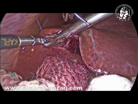 Wpływ założenia szwów na krwawienie z łożyska wątroby podczas cholecystektomii laparoskopowej