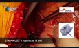 Tamponada serca po implantacji okludera