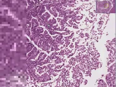 Gruczolakorak endometrium   