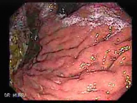 Rak włóknisty żołądka - endoskopia (2 z 15)
