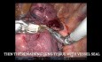 Złożona segmentektomia S9+10 płuca lewego
