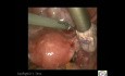 Porady i triki przy laparoskopii