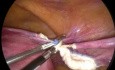 Całkowite laparoskopowe wycięcie macicy - pęknięcie worka do laparoskopii