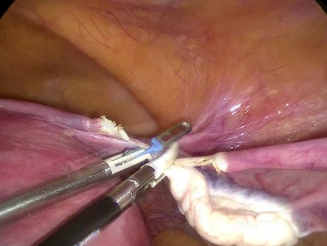 Całkowite laparoskopowe wycięcie macicy - pęknięcie worka do laparoskopii