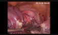 Laparoskopowa histerektomia całkowita z obustronnym usunięciem jajników i jajowodów z powodu mięśniaków