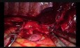 Wideotorakoskopowa złożona rękawowa lobektomia z rekonstrukcją oskrzela u pacjenta po chemioradioterapii