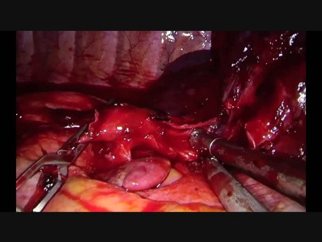 Wideotorakoskopowa złożona rękawowa lobektomia z rekonstrukcją oskrzela u pacjenta po chemioradioterapii