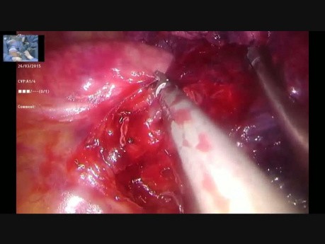 Wideotorakoskopowa lewostronna górna lobektomia z jednego cięcia u nie zaintubowanego pacjenta podczas operacji "na żywo" z Hong-Kongu