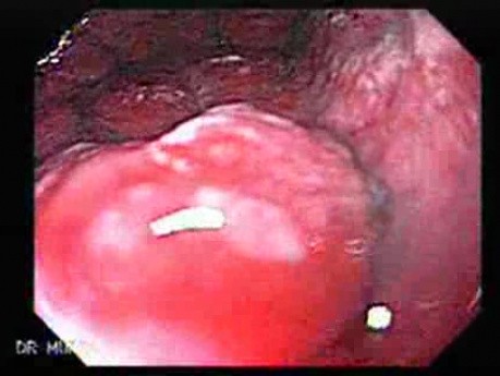 Rak włóknisty żołądka - endoskopia (4 z 15)