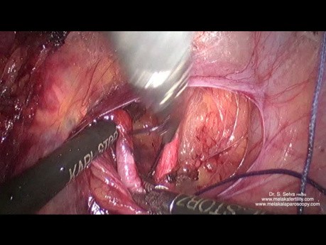 Dyssekcja i ligacja tętnicy macicznej przy bardzo dużej macicy