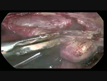 Całkowita laparoskopowa histerektomia wraz z obustronną resekcją przydatków