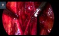 Postępowanie chirurgiczne w niepłodności na tle endometriozy