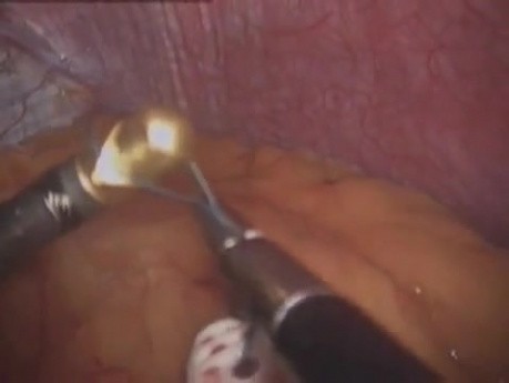 Opaska gastryczna - operacja laparoskopowa