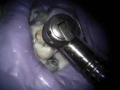 Dostęp endodontyczny do trzonowca szczęki pod mikroskopem