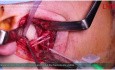 Osteosynteza podstawy wyrostka kłykciowego żuchwy z zastosowaniem dodatkowego miejsca wzmocnienia