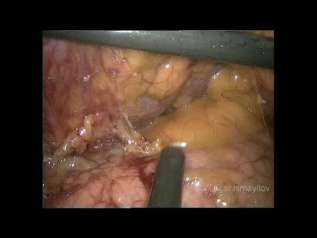 Laparoskopowa całkowita resekcja żołądka z limfadenektomią D2 u otyłego pacjenta (cały film)