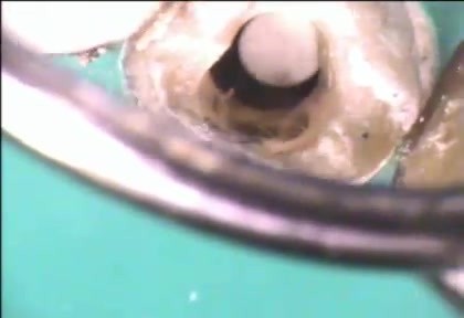 Endodoncja - zastosowanie MTA - technika