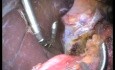  Laparo-endoskopowa jednomiejscowa (LESS) fundoplikacja sposobem Nissena