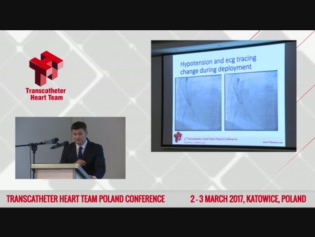 Coronary Thrombosis During TAVI