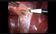 Cholecystektomia + operacja przepukliny pępkowej + podwiązanie jajowodów metodą laparoskopową