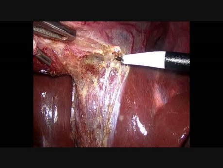 Cholecystektomia + operacja przepukliny pępkowej + podwiązanie jajowodów metodą laparoskopową