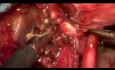 Endometrioza nerwu kulszowego - etapy operacji i anatomia