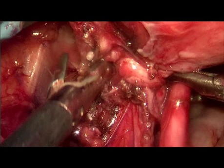 Endometrioza nerwu kulszowego - etapy operacji i anatomia