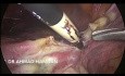 Całkowita laparoskopowa histerektomia 