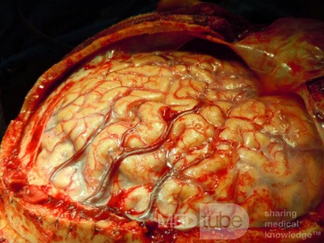 Zdjęcie mózgu, podczas operacji